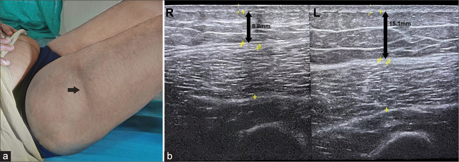 An ill-defined, horizontal, and band like depression on the anterolateral aspect of right thigh (black arrow); (b): Ultrasound image of thighs showing reduced thickness of subcutaneous fat layer (double headed black arrows) on the right side when compared to the left.