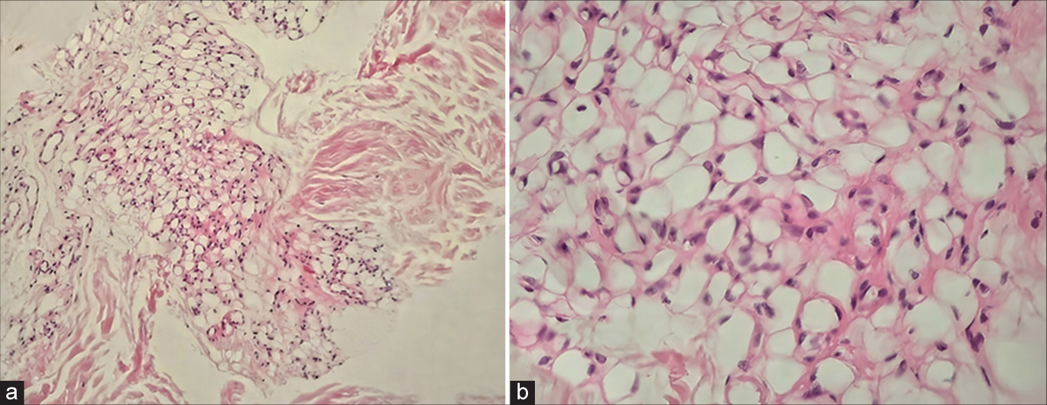 Histopathology showing diminutive fat lobules in subcutis (H&E, ×100); (b): Higher magnification showing fat lobules composed of small to medium-sized lipocytes and devoid of inflammatory cells (H&E, ×400).