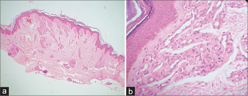 Multiple lobules composed of plump endothelial cells lining vascular spaces with inconspicuous lumens and endothelial cell proliferation in the dermis. (a): Hematoxylin and eosin ×40; (b): Hematoxylin and eosin ×400.
