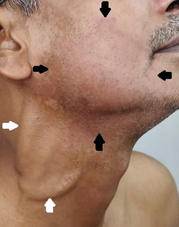 Cord like, swellings on the right side of neck (white arrow), and hypoesthetic, erythematous patch on the right side of the lower cheek extending to the neck (borders marked by black arrows) in a patient with borderline tuberculoid leprosy.