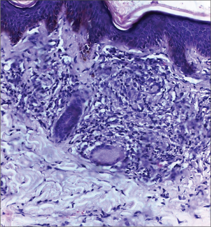 Skin biopsy from the hypoesthetic, erythematous patch on the lower half of cheek showing epithelioid granuloma impinging on the epidermis, Langhan’s giant cells, and intra-granuloma and dermal edema suggestive of borderline tuberculoid leprosy with type 1 lepra reaction (H and E, ×200).