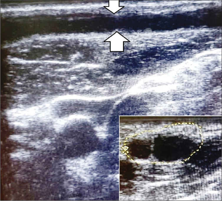High resolution ultrasound imaging done using 8–18 MHZ linear transducer of Esaote ultrasound machine in a patient with borderline tuberculoid leprosy with type 1 lepra reaction: Longitudinal sonogram showing linear hypoechoic structure suggestive of enlarged great auricular nerve (area between the white arrows); inset: Transverse sonogram showing two well defined, oval, hypoechoic structures suggestive of enlarged fascicles (encircled area) of great auricular nerve (cross-sectional area 55 mm2).