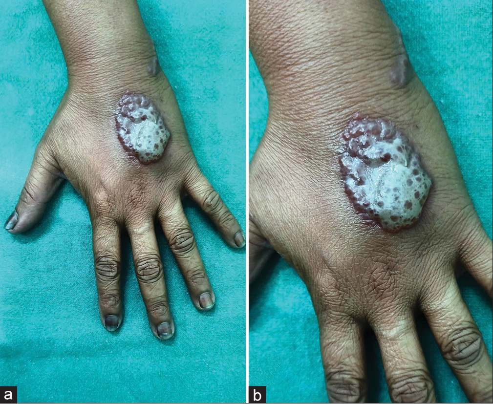 (a): Multiloculated tense bulla formed at the site of docetaxel extravasation. (b): A closer image of the bulla; a few vesicles are seen proximal to the bulla.