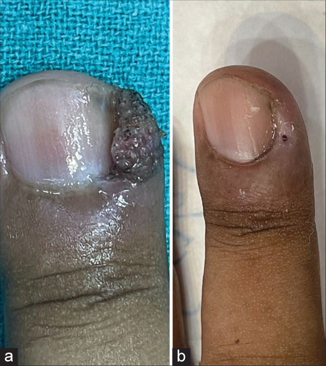 (a) Periungual wart at baseline. (b) Complete clearance at 2 weeks.