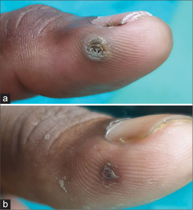 (a) Palmar wart at baseline. (b) Near complete clearance after two sittings of intralesional bleomycin.