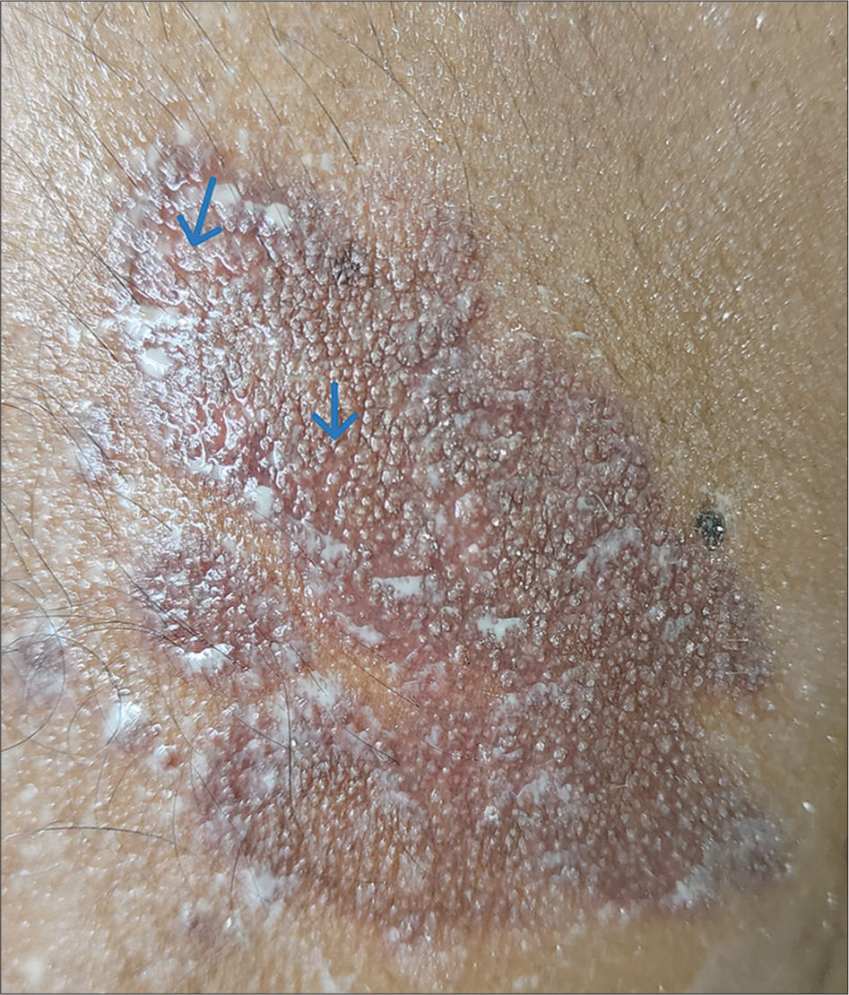 Increased sweating in lesional skin on starch iodine test (blue arrow).