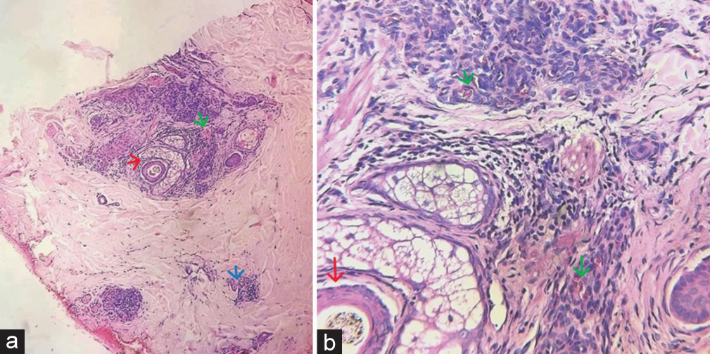 (a): Biopsy from the plaque on right arm showing eccrine glands (blue arrow), hair follicles (red arrow), and lobules of capillarysized vessels (green arrow) encircling the hair follicle in the dermis (Hematoxylin & eosin, ×100); (b): Histopathology from the plaque on right arm showing lobules of capillary-sized vessels (green arrow) encircling the hair follicle in the dermis (Hematoxylin & eosin, ×400)