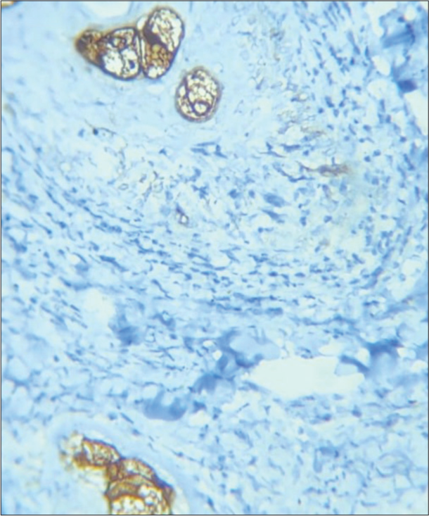 Biopsy from plaque on right arm cells showing positive for epithelial membrane antigen (Immunohistochemistry, ×20).