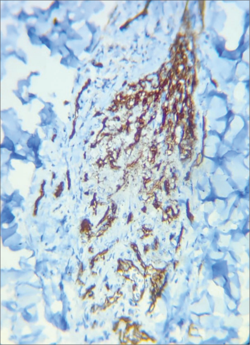 Biopsy from plaque on right arm cells showing positive for CD 31 (Immunohistochemistry, ×40).