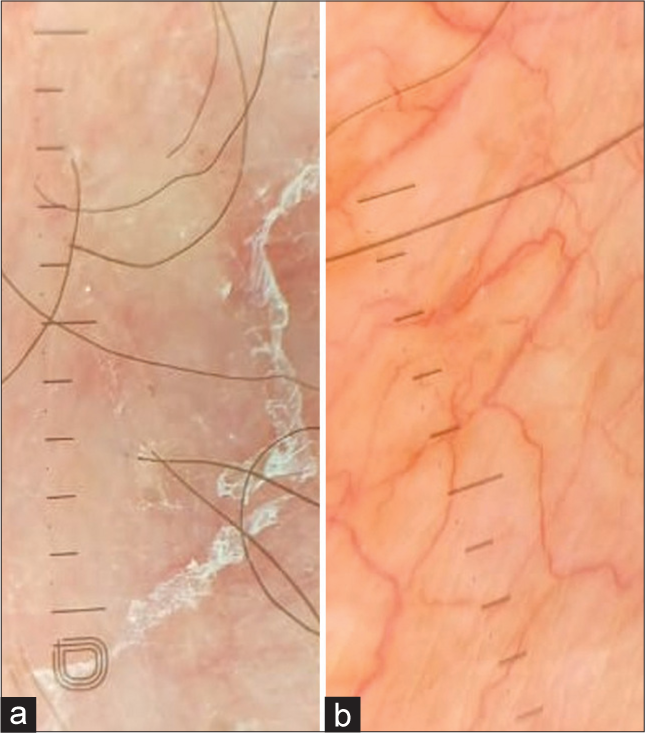 (a): Dermoscopy showing diffuse erythema, white peripheral scales, DermLite DL5, ×10 non-polarized; (b): Serpentine and branching vessels (DermLite DL5, ×10, polarized).