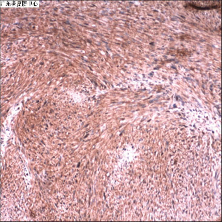 S100 (+ +) stain using S-100 immunoperoxidase shows intensely positive reaction. Reduced from ×100.