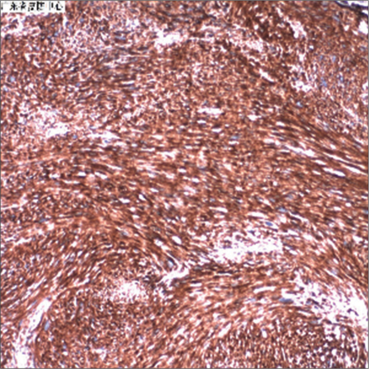 Immunohistochemical staining of tumor with vimentin showing intracellular expression of vimentin (×100).