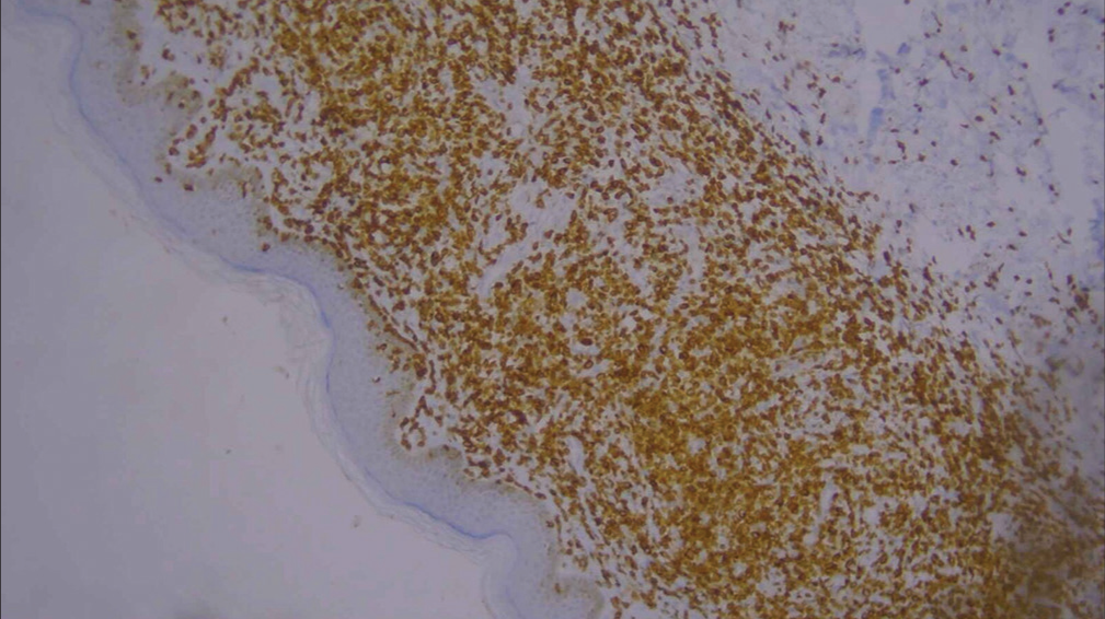 Low-power image of immunohistochemistry showing CD3 positivity (10×).