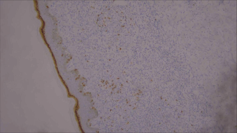 Low-power image of immunohistochemistry showing CD8 positivity (10×).