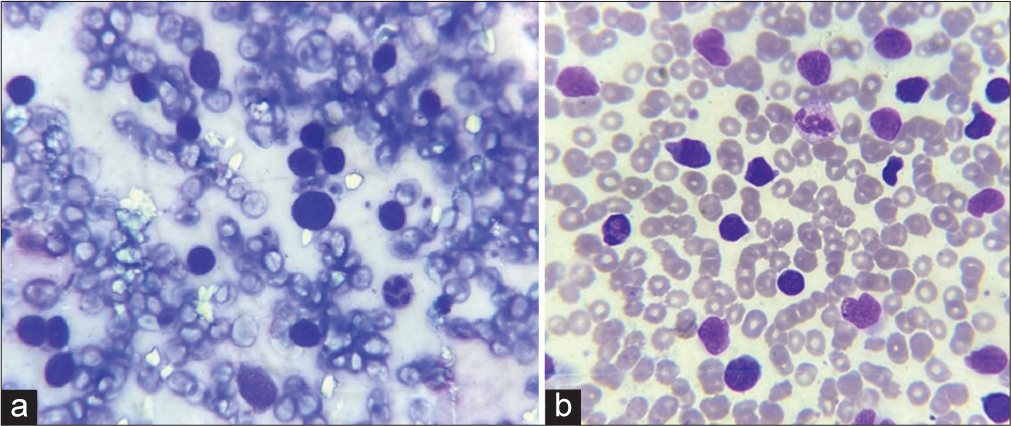 (a): Slit skin smear showing atypical cells with hyperchromatic nuclei, (Leishman stain, ×1000); (b): peripheral smear showing malignant lymphocytes, (Leishman stain, ×1000).