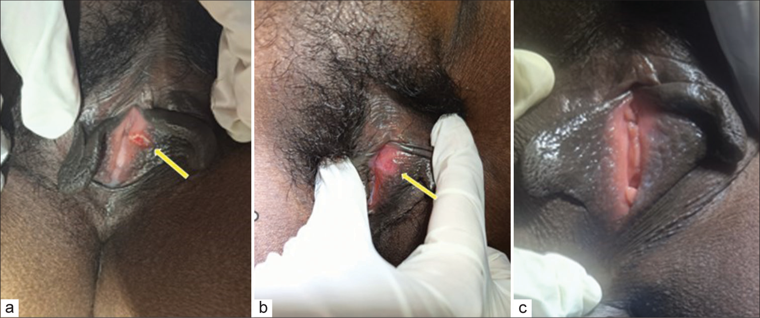 The ulcer (yellow arrow) at (a): Presentation; (b): After 2 weeks; (c): After 3 weeks.