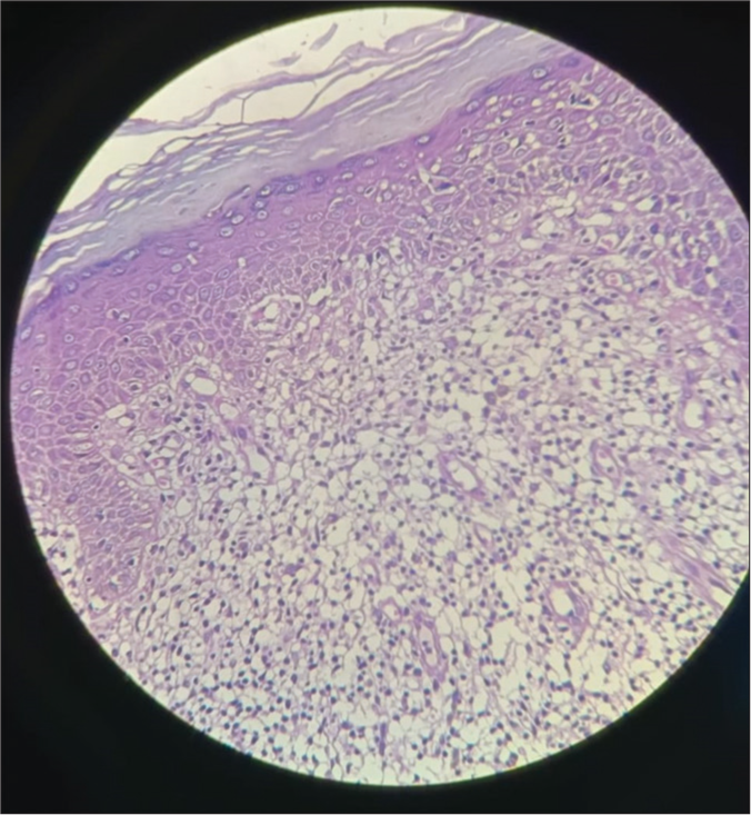 Histopathology image showing hyperkeratosis, basal cell vacuolar degeneration, and pigment incontinence in the epidermis. In the dermis, inflammatory infiltrate is composed of a band of lymphocytes and homogenization of collagen with mild edema (Hematoxylin and eosin stain ×40).