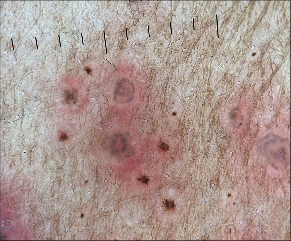 Dermoscopy (Illuco, IDS-1100) showing brownish crusts with polyglobular structures and background erythema (Polarized, ×20).