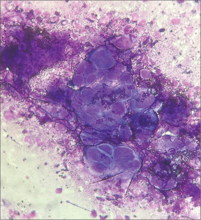 Tzanck smear showing multinucleated giant cells (Giemsa stain ×1000).