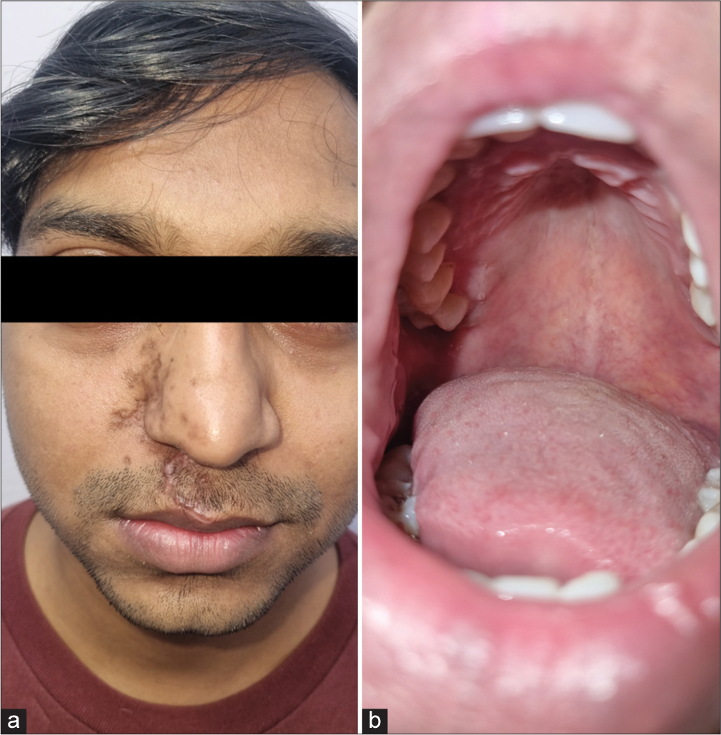 Resolution of (a): Cutaneous and (b): oral lesions following treatment.