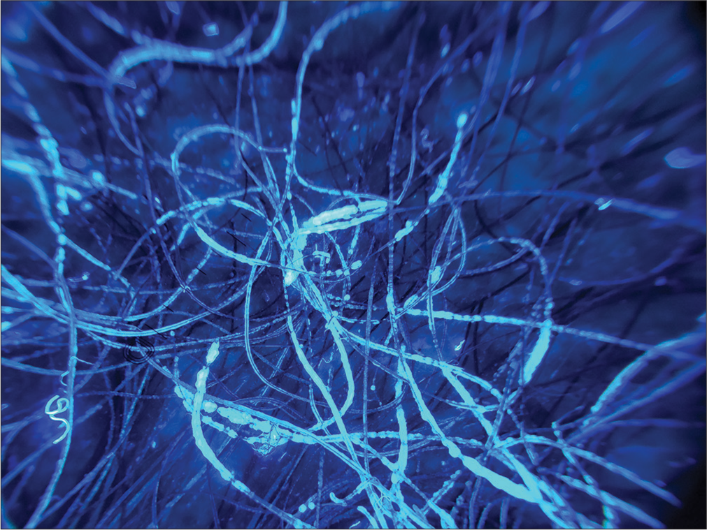 Ultraviolet-induced fluorescence trichoscopy showing bluish fluorescent concretions (DermLite DL5, ×20).