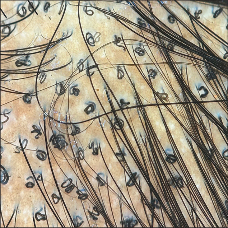 Trichoscopy (HeineDELTA one) of the scalp (polarized; 10×).