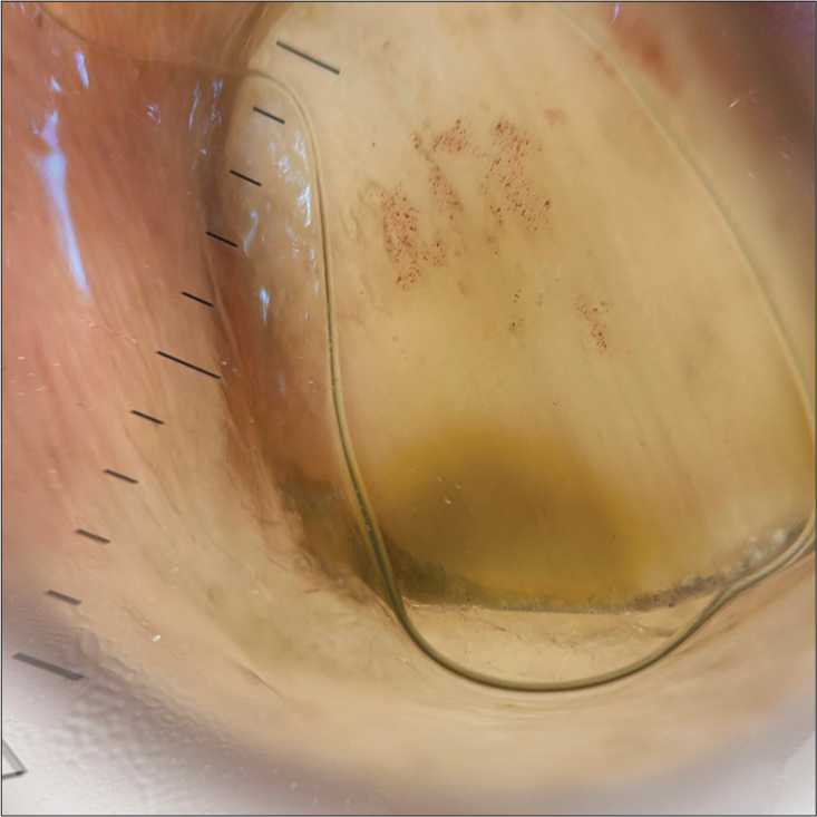 Onychoscopy (HeineDELTA one) of right ring fingernail (polarized; 10×).