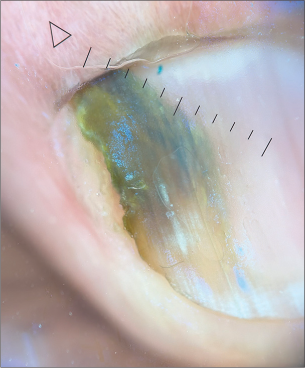 Onychoscopy (HeineDELTA one) of left ring fingernail (polarized; 10×).