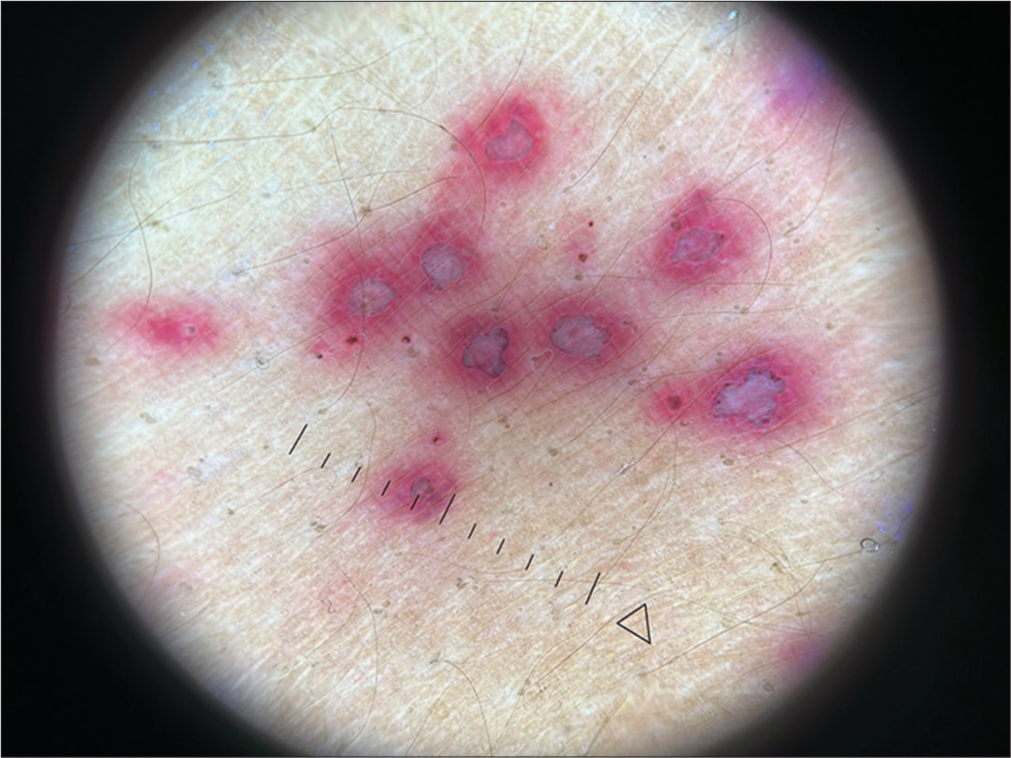 Dermoscopy (HeineDELTA one) of lesions on the abdomen (polarized; 10×).