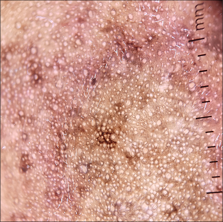 Dermoscopy showing pseudoreticular network and dilated follicular openings (DermLite DL4 ×10).