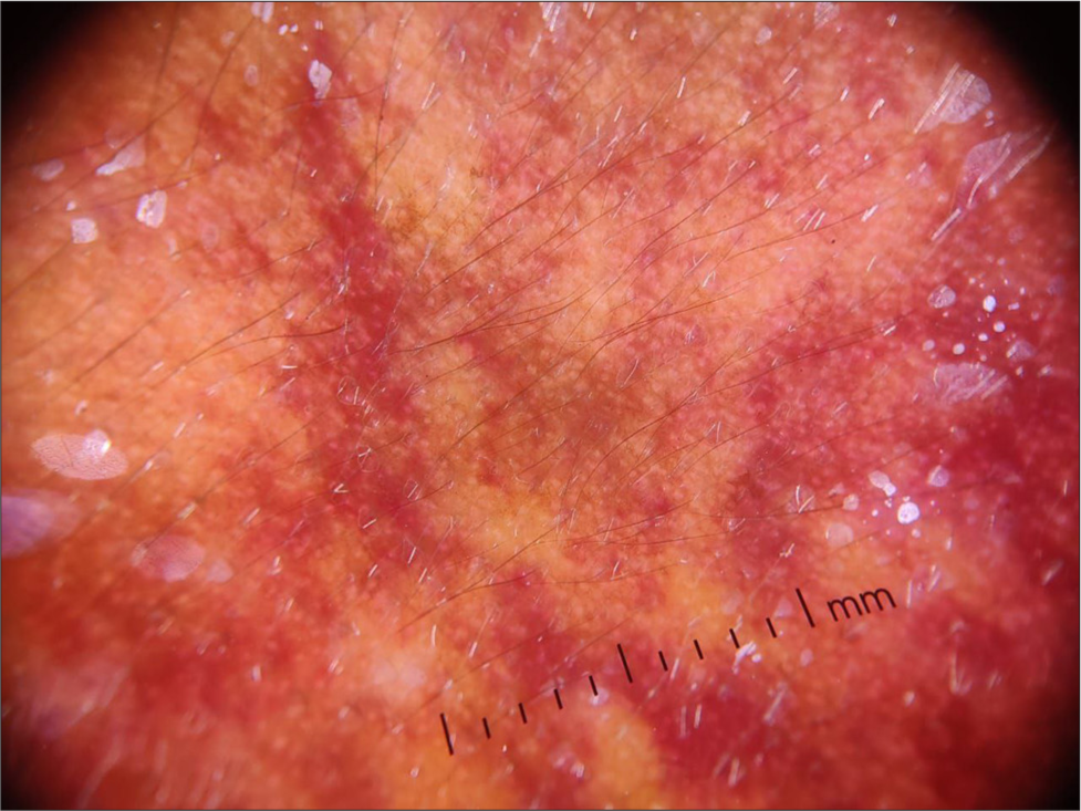 Dermoscopy showing reddish areas suggestive of dilated blood vessels (DermLite DL4 dermoscope; ×10 magnification).