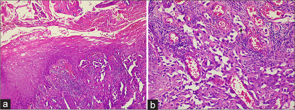 (a): Ill-defined neoplasm of anastomosing vascular channels infiltrating through dermal collagen (H&E, x10); (b): Hobnail appearance (H&E, x40). H&E: Hematoxylin and eosin.