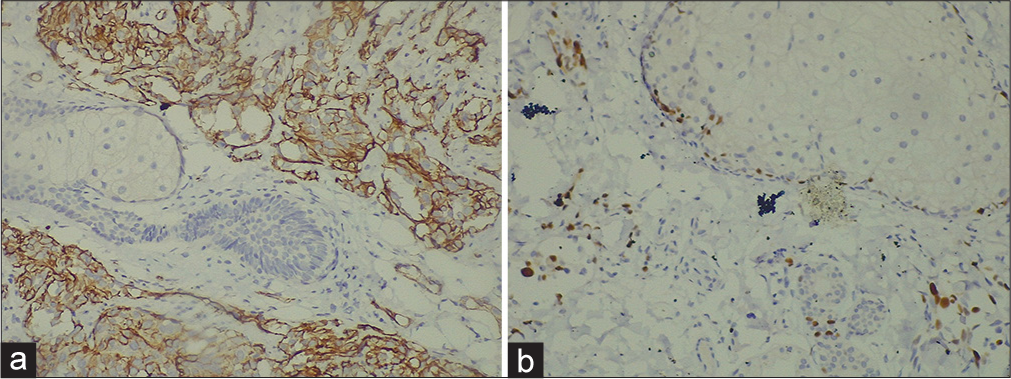 (a): Immunohistochemistry (IHC) positive for CD31 (40×); (b): IHC positive for CD34 (40×).