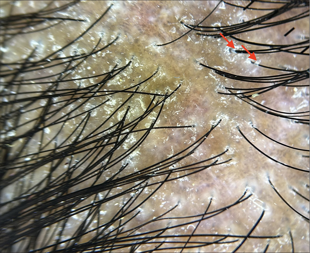 Dermoscopy (HeineDELTA one) of scalp (polarized; ×10) showing marked structures (red arrows).