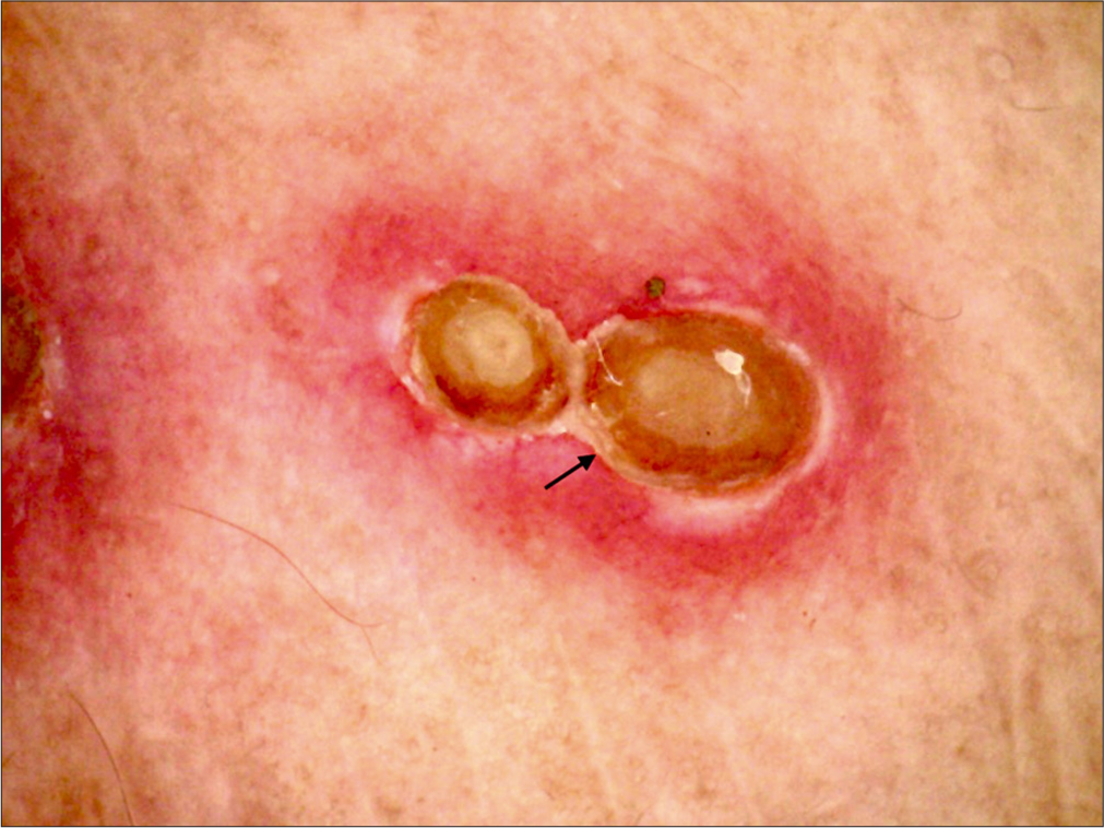 Dermoscopy (AM7115MZT Dino-Lite Edge 3.0 digital microscope) of lesions on the right thigh (polarized; ×20) showing marked structure (black arrow).