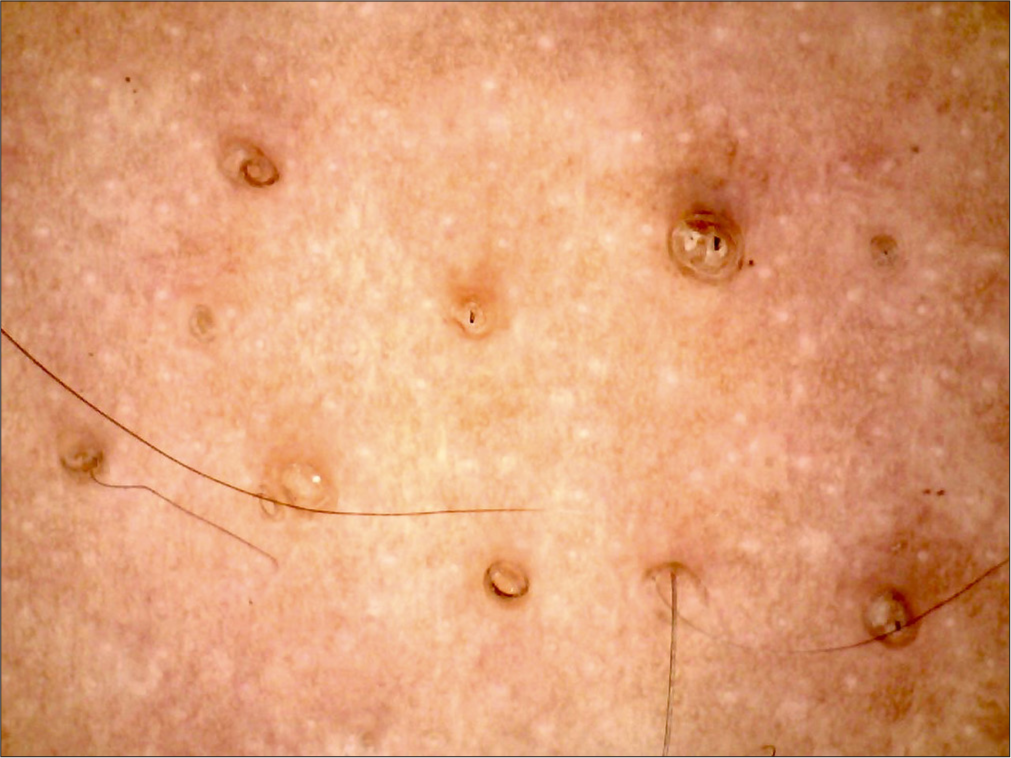 Dermoscopy (AM7115MZT Dino-Lite Edge 3.0 digital microscope) of lesions on the arm (polarized; ×35).