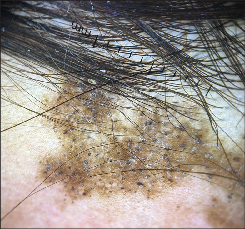 Dermoscopy (HeineDELTA one) of scalp (polarized; ×10).