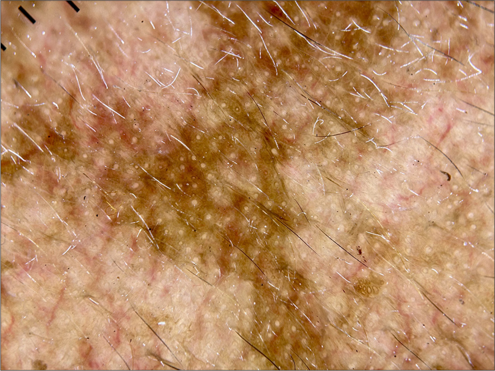 Dermoscopy (HeineDELTA one) of right cheek (polarized; ×10).