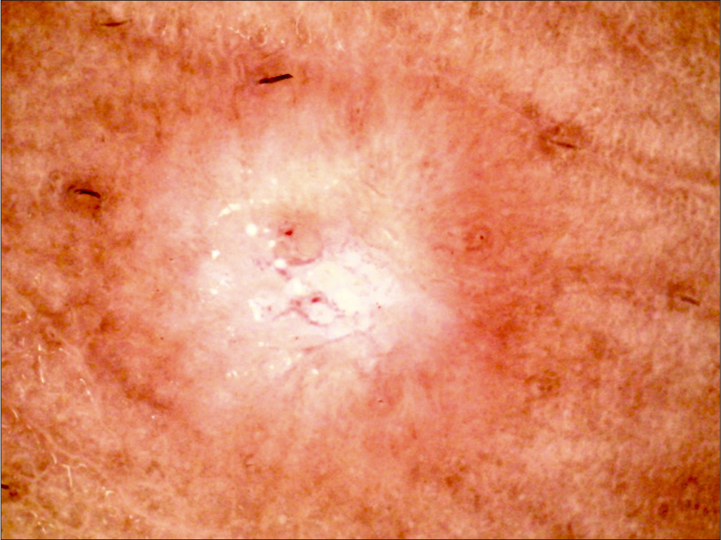 Dermoscopy (AM7115MZT Dino-Lite Edge 3.0 digital microscope) of lesions on the right leg (polarized; ×35).