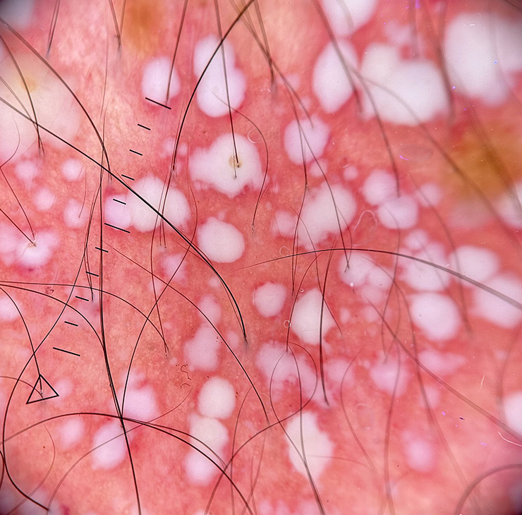 Dermoscopy (HeineDELTA one) of lesions on the abdomen (polarized; ×10).